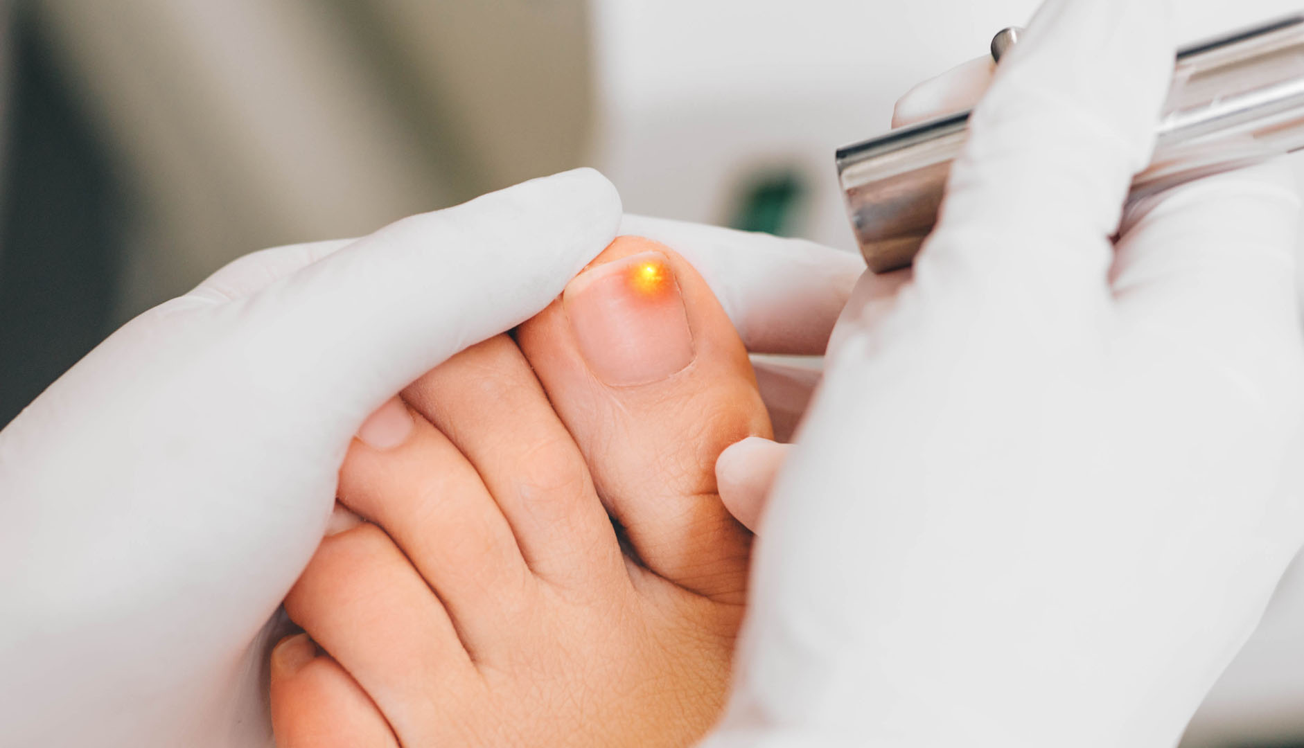 Nail fungal infection: Causes, treatment, and symptoms
